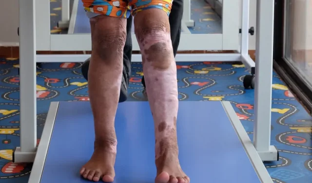 Tyrėjai 3D spausdina bekraštinius odos transplantatus nudegimų aukoms